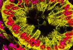 Worse Survival for BRCA Germline Mutation Carriers in Pancreatic CA Worse Survival for BRCA Germline Mutation Carriers in Pancreatic CA