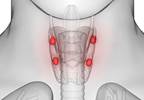 Cinacalcet May Delay Surgery for Secondary Hyperparathyroidism Cinacalcet May Delay Surgery for Secondary Hyperparathyroidism