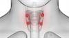 Cinacalcet May Delay Surgery for Secondary Hyperparathyroidism Cinacalcet May Delay Surgery for Secondary Hyperparathyroidism