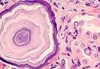 Postoperative Radioactive Iodine Ablation Effective in Reducing Disease Recurrence in Low-Risk Thyroid Cancer Postoperative Radioactive Iodine Ablation Effective in Reducing Disease Recurrence in Low-Risk Thyroid Cancer