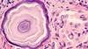 Postoperative Radioactive Iodine Ablation Effective in Reducing Disease Recurrence in Low-Risk Thyroid Cancer Postoperative Radioactive Iodine Ablation Effective in Reducing Disease Recurrence in Low-Risk Thyroid Cancer
