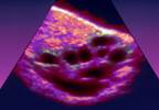 International PCOS Network Issues New Guidelines for Management and Diagnosis of PCOS International PCOS Network Issues New Guidelines for Management and Diagnosis of PCOS