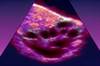 International PCOS Network Issues New Guidelines for Management and Diagnosis of PCOS International PCOS Network Issues New Guidelines for Management and Diagnosis of PCOS