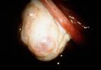 Vitamin D Deficiency Associated With Lower Success Rates of Fertility Treatment in PCOS Vitamin D Deficiency Associated With Lower Success Rates of Fertility Treatment in PCOS