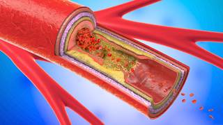 Obesity was associated with an increased carotid necrotic core volume and calcification in patients with and without type 2 diabetes. Obesity was associated with an increased carotid necrotic core volume and calcification in patients with and without type 2 diabetes.