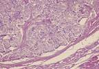 RET Inhibitor Gets Breakthrough Treatment Status for Medullary Thyroid Cancer RET Inhibitor Gets Breakthrough Treatment Status for Medullary Thyroid Cancer