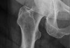 Drug Holidays May Reduce Risk for Atypical Femur Fracture Drug Holidays May Reduce Risk for Atypical Femur Fracture