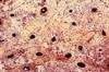 Bone-Derived Factors in the Treatment of Diabetes Bone-Derived Factors in the Treatment of Diabetes