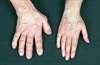 Acromegaly Outlook Improves With Better Diagnostics and Treatment Acromegaly Outlook Improves With Better Diagnostics and Treatment