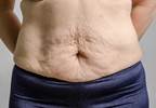 Obesity Subtype May Determine Outcomes After Bariatric Surgery Obesity Subtype May Determine Outcomes After Bariatric Surgery