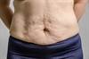 Obesity Subtype May Determine Outcomes After Bariatric Surgery Obesity Subtype May Determine Outcomes After Bariatric Surgery