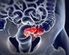 Assessing the Outcome of a Colorectal Cancer Screening Outreach Strategy in Primary Care Assessing the Outcome of a Colorectal Cancer Screening Outreach Strategy in Primary Care