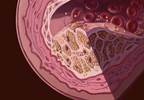 Familial Hypercholesterolemia: An Underdiagnosed Disease Gets a Second Look Familial Hypercholesterolemia: An Underdiagnosed Disease Gets a Second Look