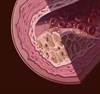 Familial Hypercholesterolemia: An Underdiagnosed Disease Gets a Second Look Familial Hypercholesterolemia: An Underdiagnosed Disease Gets a Second Look