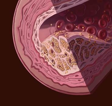 Familial Hypercholesterolemia: An Underdiagnosed Disease Gets a Second Look Familial Hypercholesterolemia: An Underdiagnosed Disease Gets a Second Look