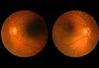 GLP-1 Receptor Agonists Not Associated With Increased Diabetic Retinopathy Risk GLP-1 Receptor Agonists Not Associated With Increased Diabetic Retinopathy Risk