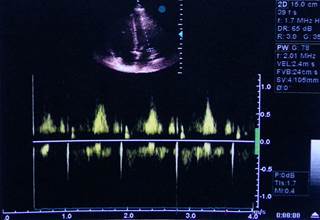 Investigators sought to determine how severity of maternal overweight and obesity affects rates of complex and specific heart defects in offspring. Investigators sought to determine how severity of maternal overweight and obesity affects rates of complex and specific heart defects in offspring.